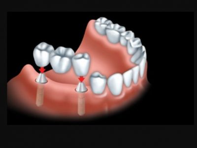 2017-04 Dental Crown CDA Image