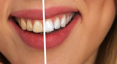 Tips for a White Bright Smile
