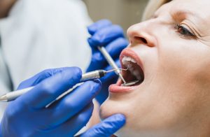 Woman with Receding Gums Check-up