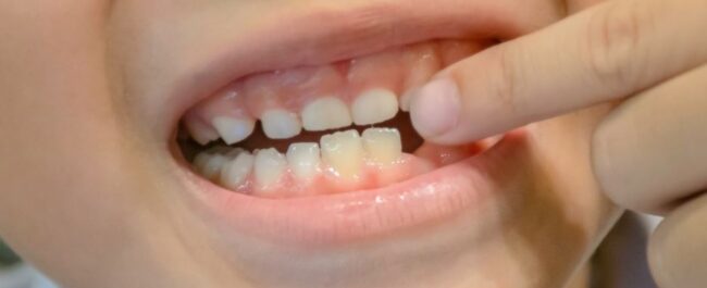 What If My Child s Baby Teeth Aren t Falling Out 