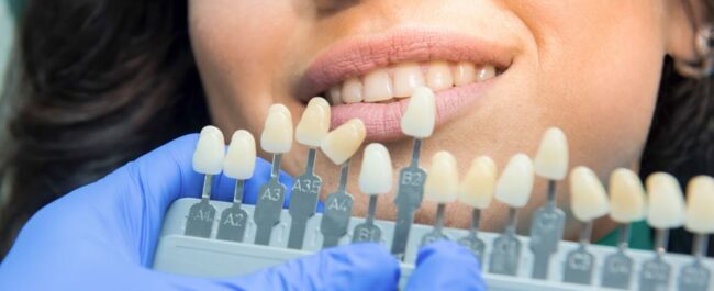 Woman Teeth Whitening Shades