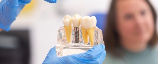 Dental Replacement Choice Implant or Bridge